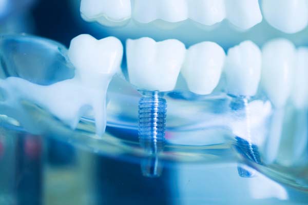 What Your Oral Surgeon Wants You To Know About Dental Implants