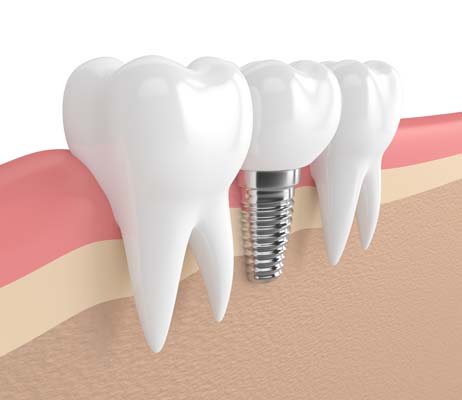 Dental Implant Surgery Denver, CO