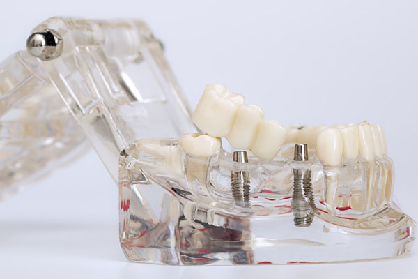 Why Choose Implant Supported Dentures? Top Benefits Explained