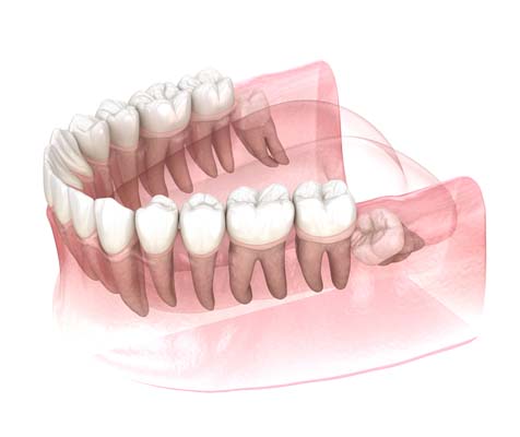 What Complications Can Happen If A Wisdom Tooth Is Not Removed As A Teenager